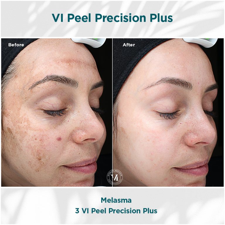 Melasma_01