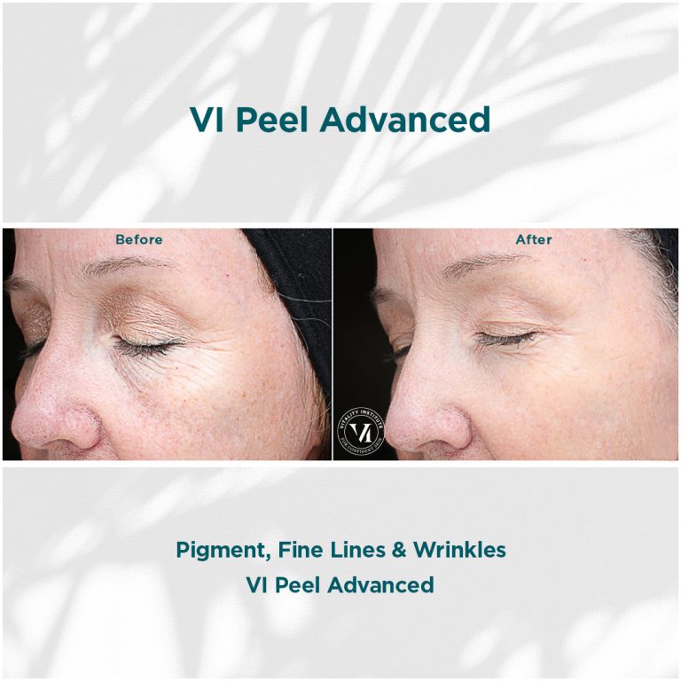 Pigment, Fine Lines _ Wrinkles