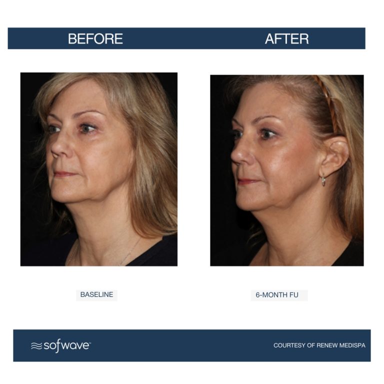 Set-82-Full-Face-Neck