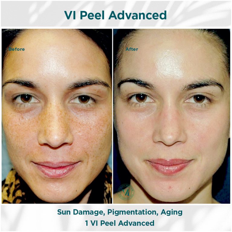 Sun Damage, Pigmentation _ Aging