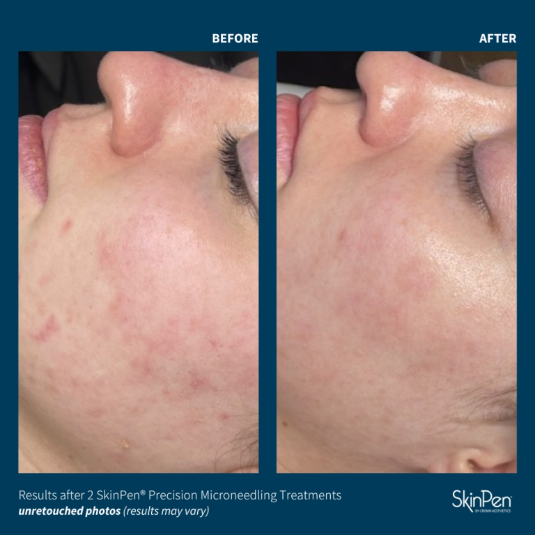 Skinpen before and after pic 1
