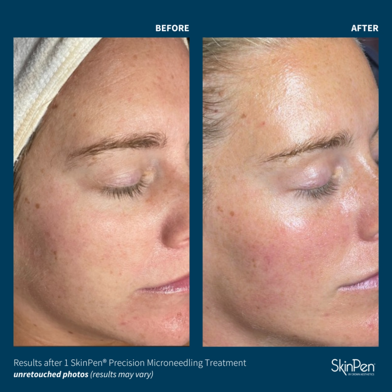 Skinpen before and after pic 2