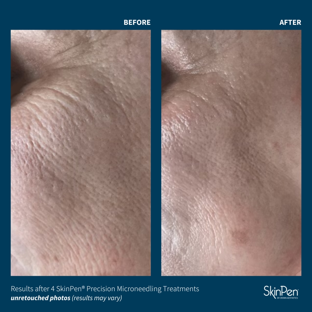 Skinpen before and after pic 3